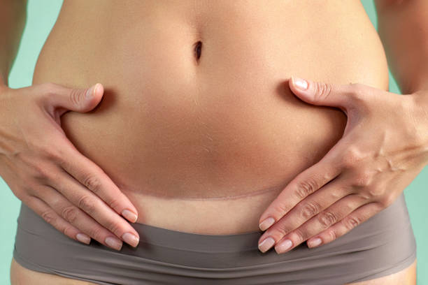 Terapia blizny